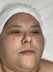 PEELING ELIMINAR MANCHAS